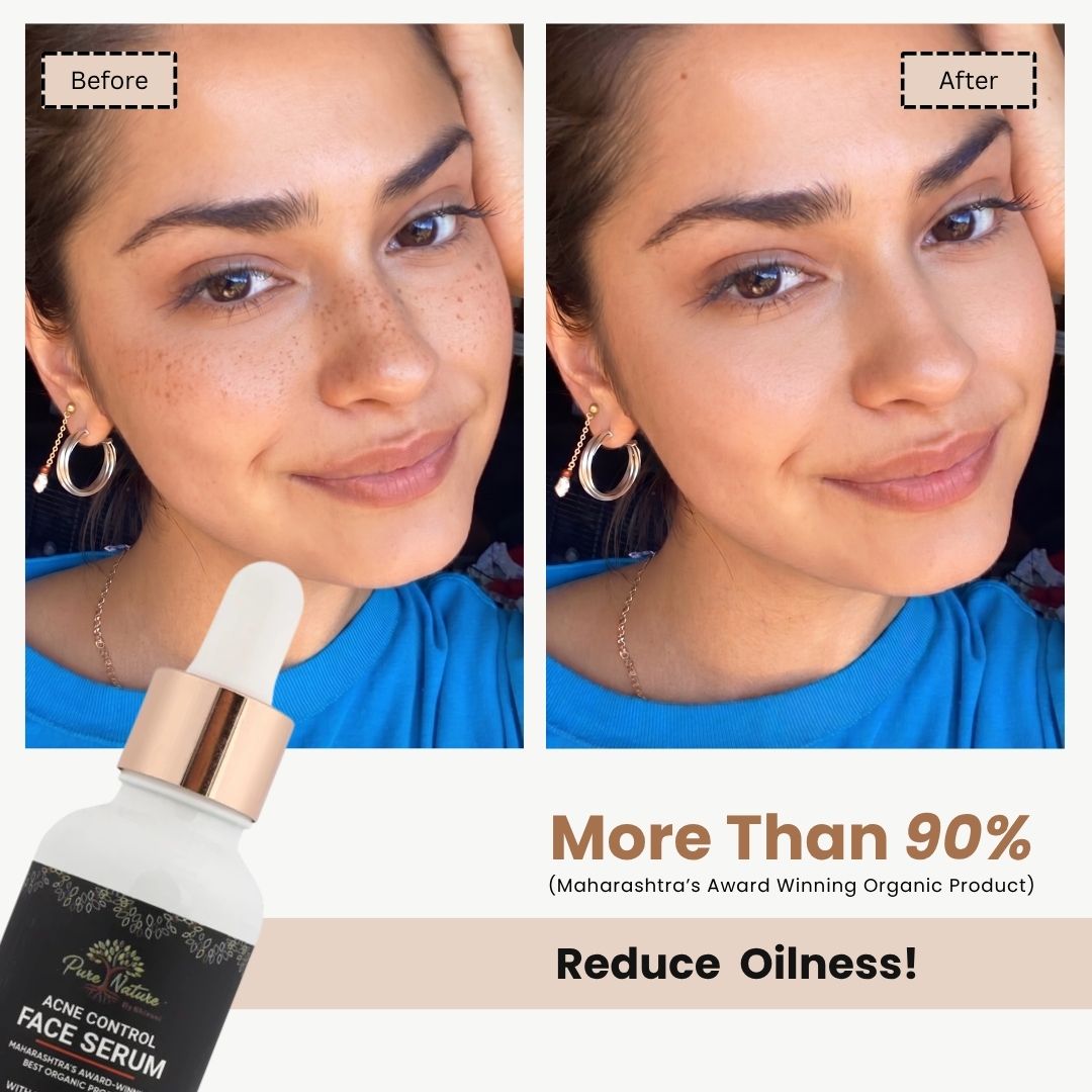 Pure Nature Acne Control Face Serum