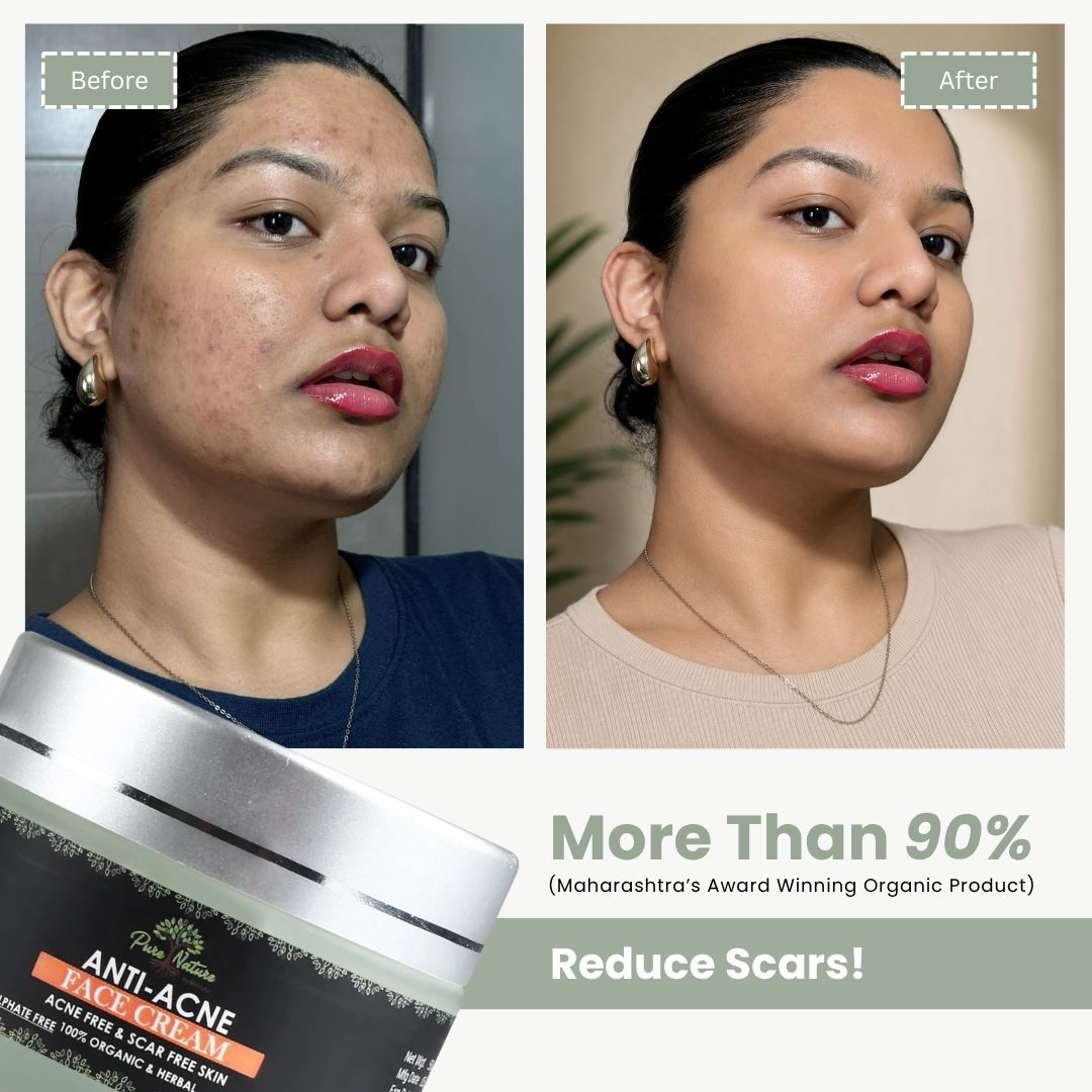 Anti-Acne Face Cream