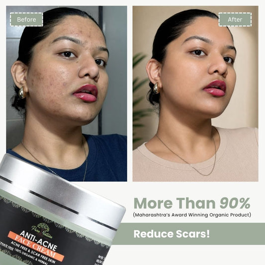 Pure Nature Anti-Acne Face Cream