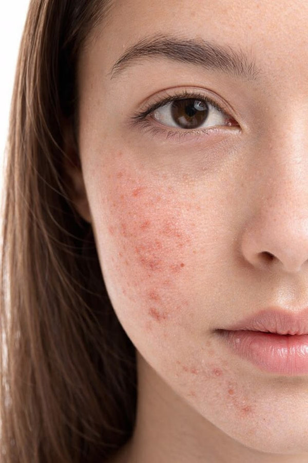 Acne Care